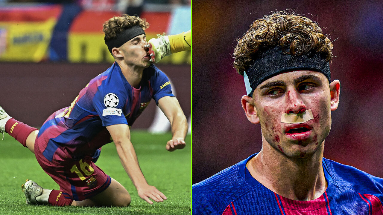 Barça’s Fermín López Hit in Face by Atlético Madrid Goalkeeper’s Studs in Shocking Match Moment